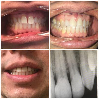 This patient did not like the gap in his teeth. We closed his gap and corrected his cross bite.