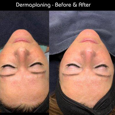 Dermaplaning at The Wax Specialists