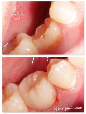 Over retained baby teeth can cause adjacent teeth to move or the bite to change. They may be restored minimally.