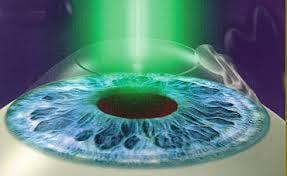 We offer the Allegretto 400 Wavelight Laser Most Advanced Technology and No Cut Lasik