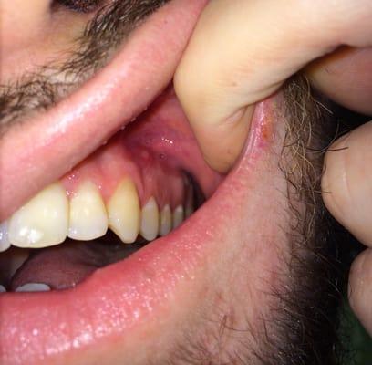 The sore on my gums.