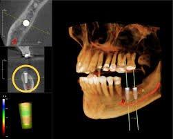 Sample CT Scan - Implant simulation with mandibular canal for accurate implant placement.