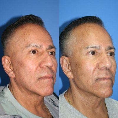 62 year old patient desiring a smaller, more natural nose, shown six months post-rhinoplasty