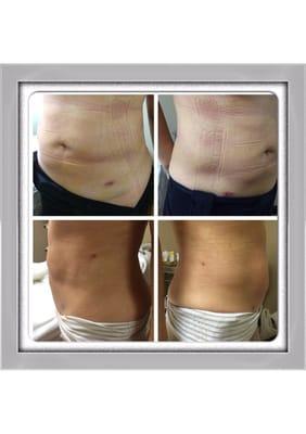 Progress Before and after pictures of a manual lymphatic drainage treatment, performed on a client who had lyposuction.