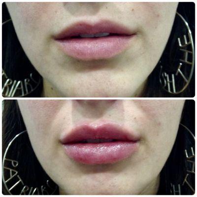 Before and after lip filler