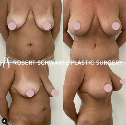 Mommy makeover- breast augmentation, breast lift, tummy tuck, liposuction of the flanks and back.