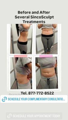 Results of several SincoSculpt and body contouring body slimming treatments