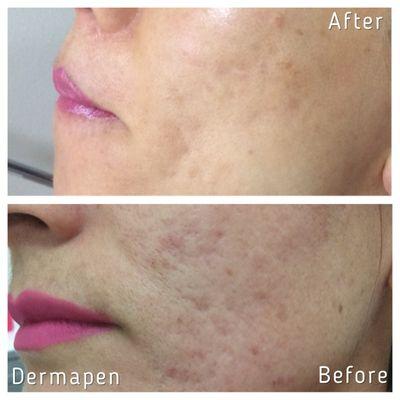 1 Dermapen session