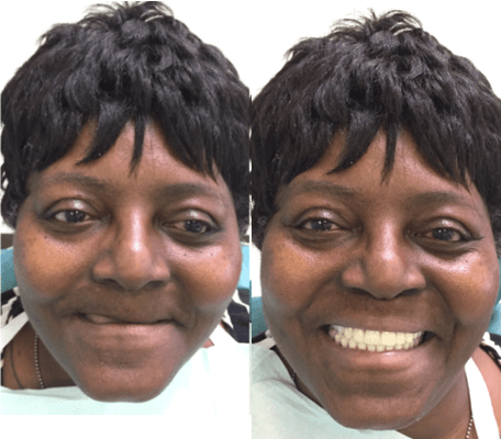 Before and After at NÜVA Smile | Clifton, NJ