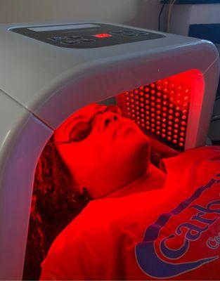 Red LED treatment for hyperpigmentation