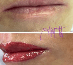 Lips/before and after.