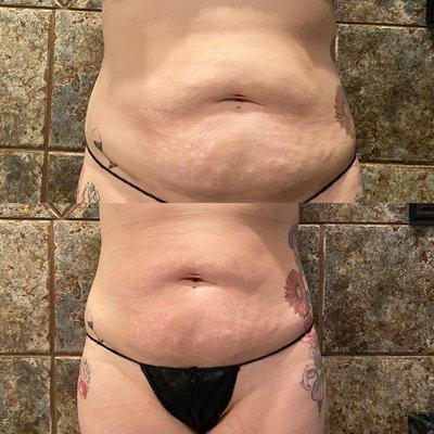 Results of Body contouring!