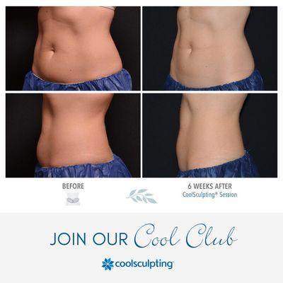 Coolsculpting Results!