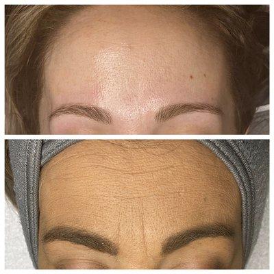 Results from one Micro Peel.