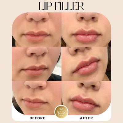 Lip filler