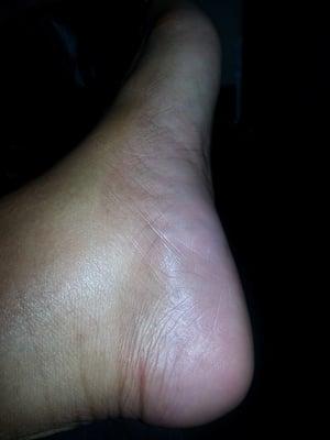 Bad Pedicure,  non licensed tech took much skin off my feet. Swollen & blistered!