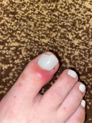 Inflamed toe / infection from the pedicure about 1 week after