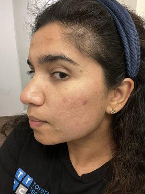 30 days post treatment