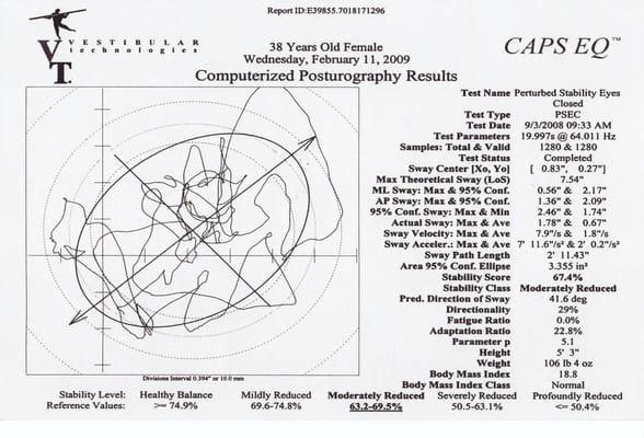 Graph and postural stability scores of a 38 year old woman are shown here.  Balance and stability issues can occur at any age.