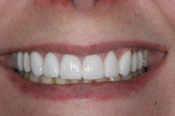 Porcelain Veneers
(after)