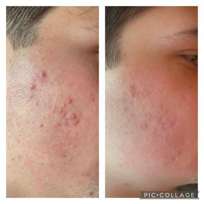 This is after just ONE treatment!