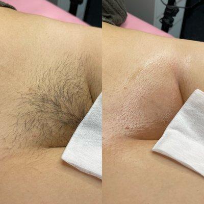 Brazilian wax