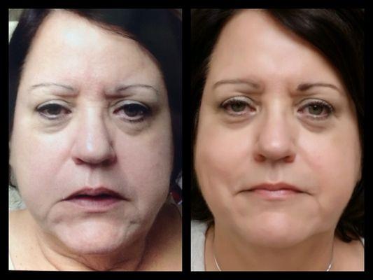 Non-Surgical Facelift