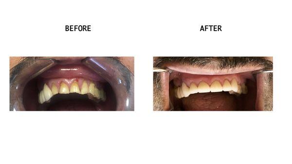 Another excited and happy patient after treatment with zirconia/porcelain crowns!