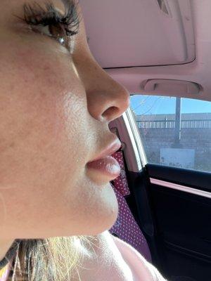 Bottom looks like filler outside my lip line . Top too