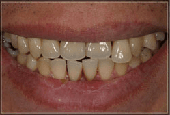 Full mouth reconstruction with veneers, crowns, and implant.