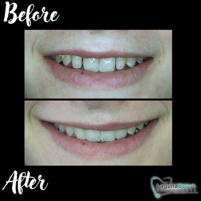 Adding a couple veneers to elevate a smile