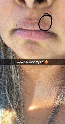 Wax burned my lip