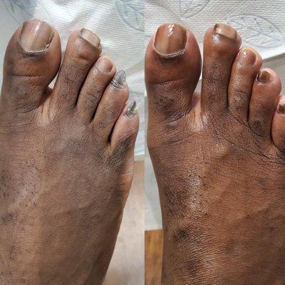 Before and After Medical Pedicure.