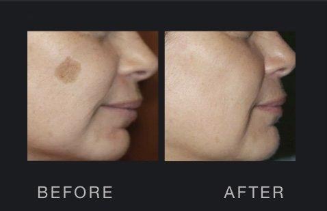 Sun Damage Removal