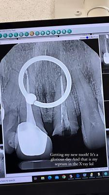 X-ray of my broken tooth