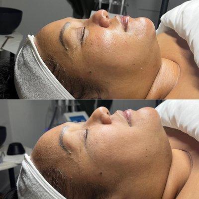 Immediate Results After ONE Customized 60 Minute Facial + Dermaplaning Add-On