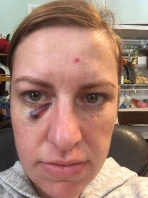 Black eye from fillers- a week after injection, and a red scar on my forehead from the Botox.