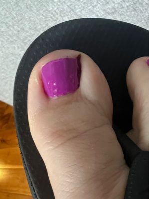 Bleeding toe