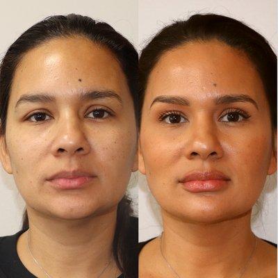 Facial Rejuvenation and balancing with dermal fillers - Chin, cheek, lips