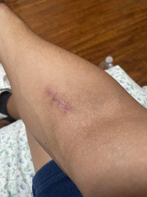 Scar from distal bicep rupture