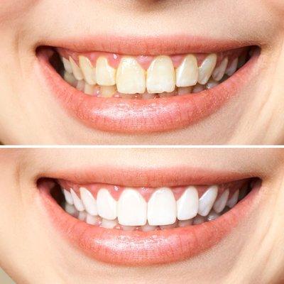 Before & After Teeth Whitening and Veneers