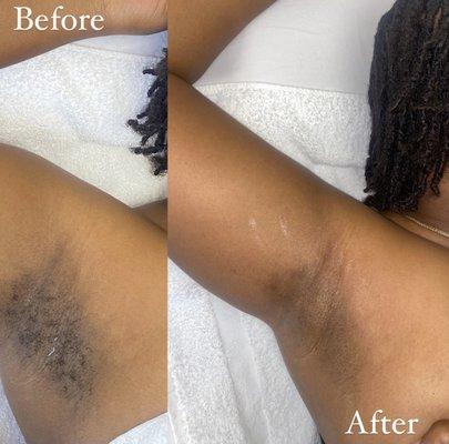 Under arm sugaring before and afer.