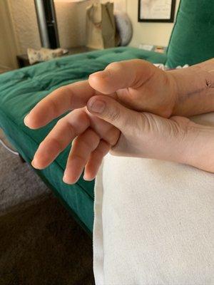 My swollen hand one week after surgery.