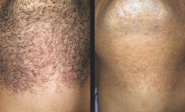 Before and after laser hair removal with Candela Gentlemax Pro