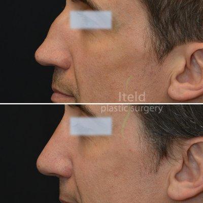 Rhinoplasty - before and after