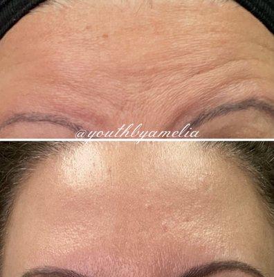 Botox/Dysport results