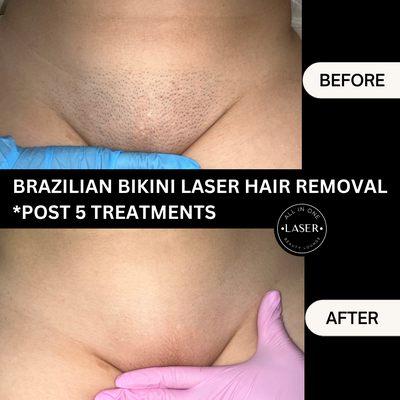 Brazilian bikini laser hair removal