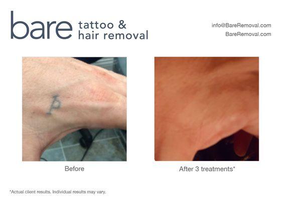 Complete laser tattoo removal in just 3 treatments!