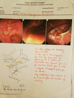 These are the ulcers found ONE MONTH LATER--LUH LIED and said they scoped my stomach. I suffered another month before these were discovered.