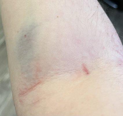 Day 1, ruptured vein, and the spot that finally had a successful draw.